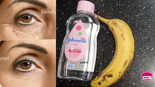 Under eye wrinkles natural Botox  How to get rid of eye wrinkles when you smile naturally [upl. by Amsirp]