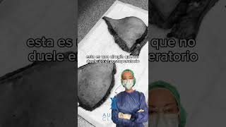 Abdominoplastia Dr Hernando Tenorio [upl. by Poyssick]