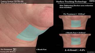 SculpSure for Submental Fat Reduction Under the Chin Fat [upl. by Odnavres890]