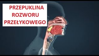 Przepuklina rozworu przełykowego《73》 [upl. by Norri54]