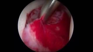 Inflammatory Synovitis  Synovectomy Surgery  Hip Specialist [upl. by Ul]