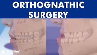 ORTHOGNATHIC surgery  All about JAW realignment surgery © [upl. by Iam754]