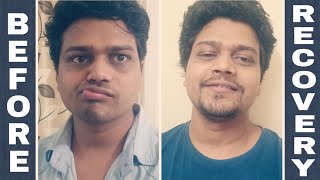 Facial paralysis  Fastest Recovery video from Bells palsy in 4 weeks SomeSukoon [upl. by Gombosi]