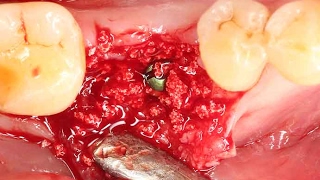 Clinical application of OSTEON™ lll Dentium alloplastic graft [upl. by Sirromaj]