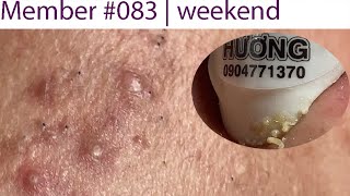 Acne Treatment Huong Da Nang 083  Member [upl. by Alonzo]