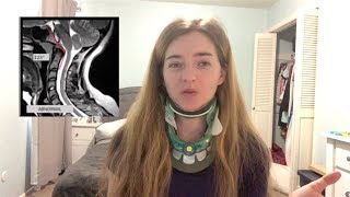 Diagnostic Testing for Craniocervical Instability CCI and Atlantoaxial Instability AAI [upl. by Oizirbaf]