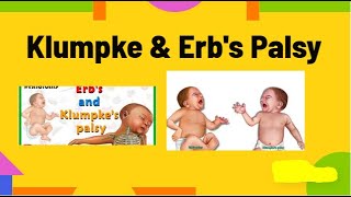 klumpke amp erbs palsy  waiters tip posture amp claw hand deformity physiotherapy knowledge [upl. by Greyson979]