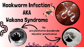 Hookworm Causes Signs and Symptoms Diagnosis and Treatment  Intestinal Nematodes  Novice Medic [upl. by Anahcar]