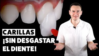 Carillas dentales ¡SIN DESGASTE Una excelente opción  CASO REAL [upl. by Llenyt]