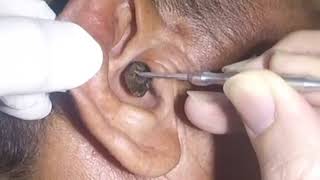 Removing MASSIVE Earwax from Mans Ear [upl. by Johannah]