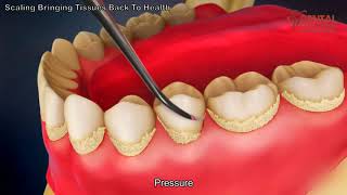 Teeth scaling to remove plaque  3d animated video  Dental Solutions Clinic Bangalore [upl. by Adrienne422]