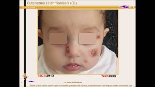 Cutaneous Leishmaniasis Clinical Archive [upl. by Dnalsor]