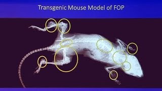 Genetic Mysteries FOP  When Bodies Turn to Bone [upl. by Okiam]