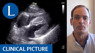 Myocarditis in a patient with COVID19 [upl. by Rodge]