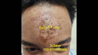 تجميل اثار الجروح و الندبات بوتوكسscar revision قبل و بعد أفضل طبيب تجميل مصر  دصابر عبد المقصود [upl. by Allmon41]