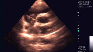 Echocardiography of Hydatide cyst in the interatrial septum [upl. by Ewolram92]