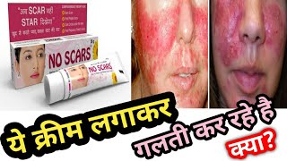 No Scar Cream Honest Review 2021 In Hindi Side Effects Uses  Price  My opinion  पूरी सच्चाई [upl. by Orton]