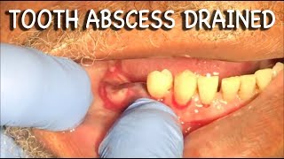 Infected Tooth Abscess Drained  Graphic⚠️ [upl. by Aralc]