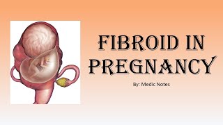 OampG Fibroid in pregnancy  effect on pregnancy and fibroid management [upl. by Arihsaj]