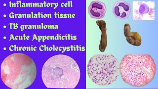 Inflammatory cell Granulation tissue TB granuloma Appendicitis Cholecystitis identificationExam [upl. by Janela950]