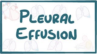 Pleural Effusion  causes symptoms diagnosis treatment pathology [upl. by Nerval295]