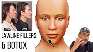 Jawline Fillers amp Botox Tips  What to Know  Beverly Hills Facial Plastic Surgeon Dr Ben Talei [upl. by Noj]