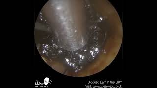 1381  Last Hope Ear Wax Removal for Patient in a lot of Discomfort [upl. by Lotson368]