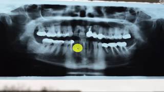 falsche diagnose keine fibroisierende osteomyelitis [upl. by Vudimir]