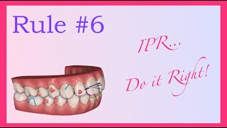 IPR  do it right  Invisalign Mini Course 7 of 8 part I [upl. by Patrizius]