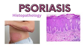 Psoriasis pathophysiology and histology  dermatology [upl. by Weissmann541]