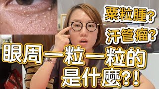 粟粒腫？汗管瘤？病毒疣？這些該怎麼處理，我來告訴你！ [upl. by Jordan]