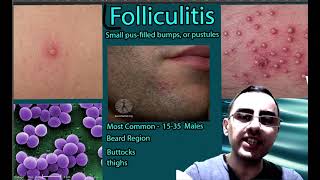 Folliculitis Symptoms causes and treatment [upl. by Suravaj765]