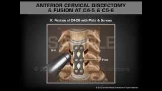 Anterior Cervical Discectomy amp Fusion at C45 and C56 [upl. by Keg401]