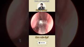 귀지형 콧물 부비동염 축농증 비염 코청소 이비인후과 rhinorrhea rhinitis sinusitis asmr ENT entdoctor [upl. by Leiruh773]