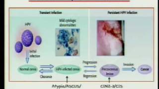 HPV and Cervical Cancer 25 Years from Discovery to Vaccine [upl. by Nomahs]