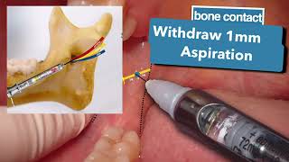 INFERIOR ALVEOLAR NERVE BLOCK أفضل شرح مبسط لطبيب الأسنان [upl. by Hilel]