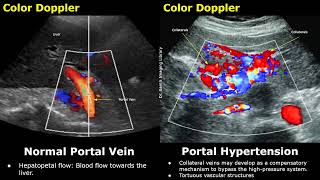 Portal Vein Color amp Spectral Doppler Ultrasound Normal Vs Abnormal Images  Liver Vascular USG Scan [upl. by Lehcnom]