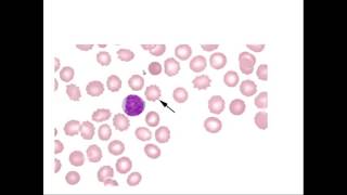 Hematoloji  Eritrosit Morfolojisi [upl. by Ajnat]