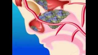 Zygomycosis Overview – Type of Fungal Infection [upl. by Ganley]