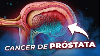 CANCER De PROSTATA Para Pacientes  Explicado FACIL [upl. by Sunil]