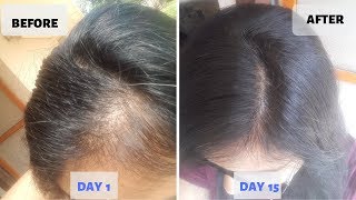 OMG  15 Days Hair Growth Miracle Treatment  Grow Long Thicken Hair  100 works [upl. by Cyna]