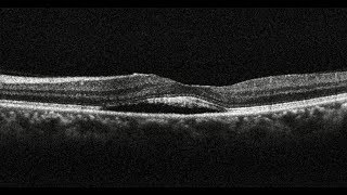 Photodynamic Therapy in Chronic Central Serous Chorioretinopathy  Retina Center Tijuana Mexico [upl. by Aihsal]