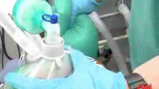 How does a Propofol injection work Dr Sanjay Gupta and Dr Raphael Gershon on CNN [upl. by Elletnahs]