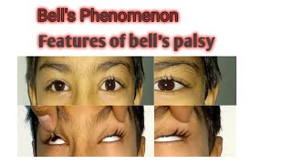 Bells phenomenon  How to examine bells phenomenon [upl. by Eijneb320]