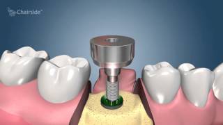 Dental Implant Procedure  Two Stage 🦷 Award Winning Patient Education [upl. by Ailene]