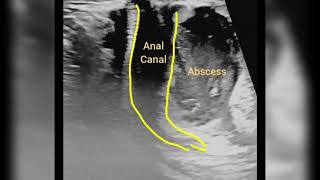 perianal abscess [upl. by Idnarb]