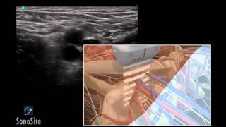 How To Ultrasound Guided Insertion of a Femoral Vein Catheter 3D Video [upl. by Marlie911]