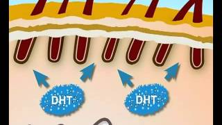 ¿QUE ES LA ALOPECIA ANDROGENETICA [upl. by Muller]