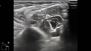 부리상완근 coracobrachialis musculocutaneous nerve [upl. by Haniraz]