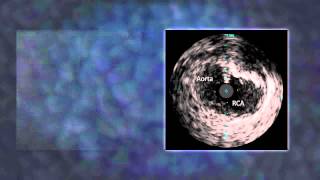 Animation IVUS Catheter in the Ostial RCA [upl. by Sussi]